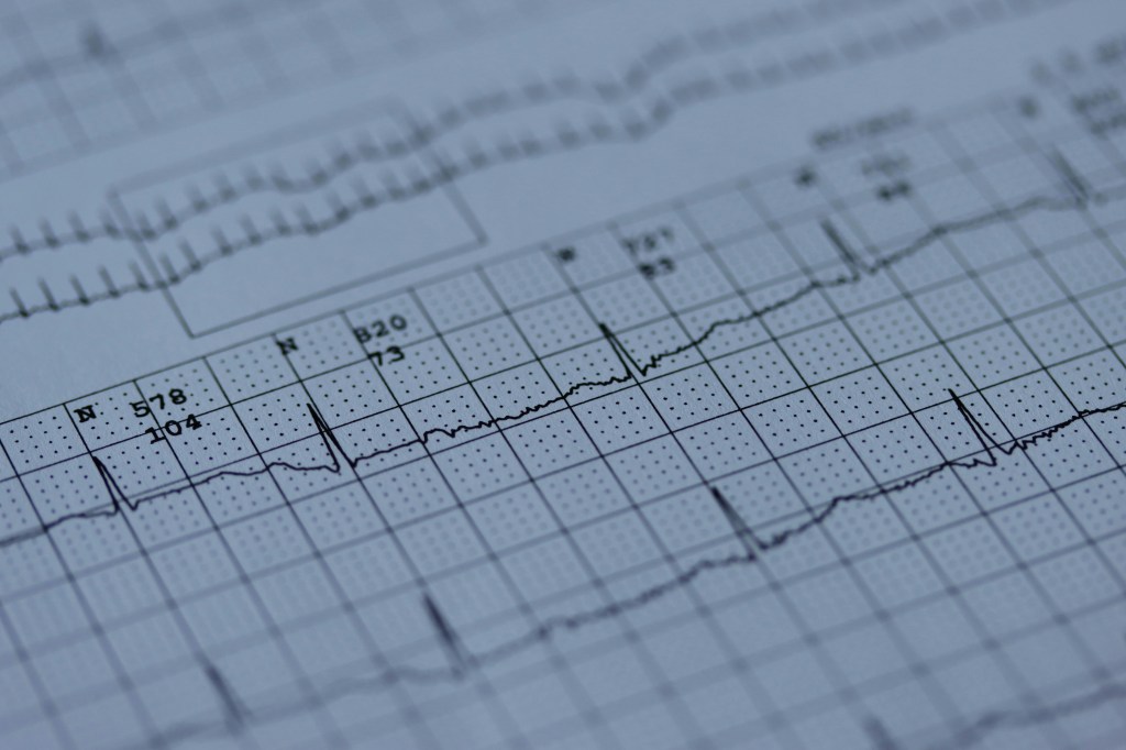 Heart Palpitations at 50:  Scarey EKG Results, and What I’m Doing&nbsp;Next
